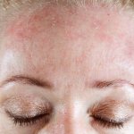 Allergic dermatitis on the face