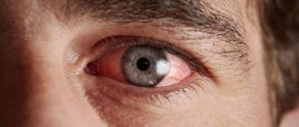 Allergic conjunctivitis of the eyes - causes and symptoms