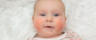 Atopic dermatitis in children
