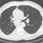 Central cancer of the right lower lobe bronchus with obstruction and metastases