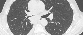 Центральный рак правого нижнедолевого бронха с обтурацией и метастазами