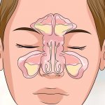 What is sinusitis: causes and treatment methods
