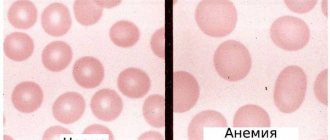 Red blood cells are normal and with anemia, macrocytosis and hyperchromia