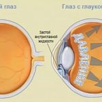 Glaucoma of the eye