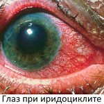 Iridocyclitis of the eye - acute and chronic