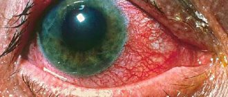 Iridocyclitis of the eye - acute and chronic
