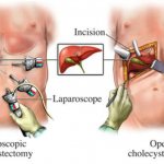 Laparoscopic and open cholecystectomy
