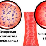 Микрофлора влагалища при бактериальном вагинозе