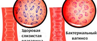 Vaginal microflora in bacterial vaginosis