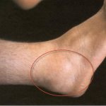 Ankle swelling