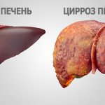 Liver with signs of cirrhosis