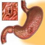 Perforated gastroduodenal ulcer