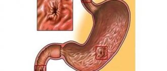 Perforated gastroduodenal ulcer