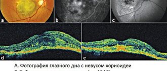 Pigmented nevus of the choroid and its treatment