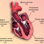 Причины кардиогенного шока