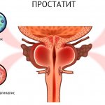 Prostatitis.jpg