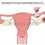Development of ectopic pregnancy