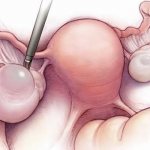 Ovarian resection