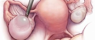 Ovarian resection