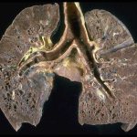 Pulmonary sarcoidosis