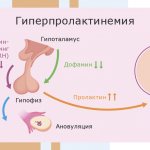 Симптомы пролактиномы у женщин - Изображение №1