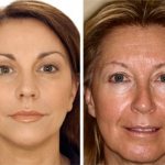 Solcoseryl for the face against wrinkles: reviews from cosmetologists, which is better gel or ointment, how to use at home
