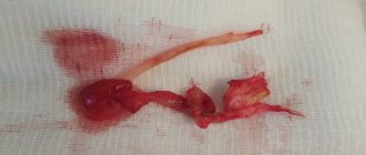 Removed atherosclerotic plaques