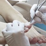 Removing nails with onychomycosis