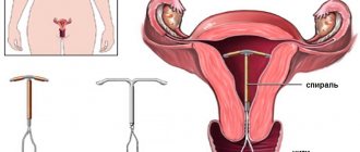 intrauterine device