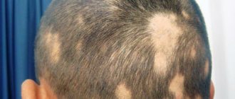 bald patches at the site of a fungal infection